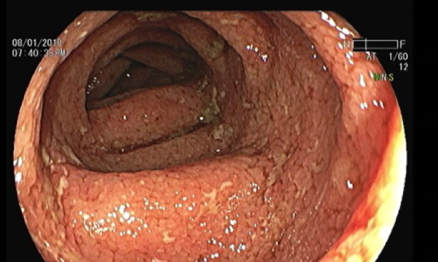 Enfermedades Inflamatorias Intestinales y COVID-19: riesgos en mayores de 70 años con terapia inmunosupresora