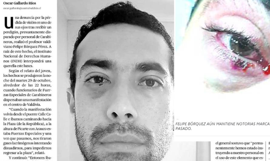 Diario Austral: Profesor de Valdivia denuncia pérdida de visión de un ojo por impacto de perdigón