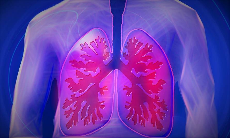 Neumonía por Covid-19 puede dejar importantes secuelas en pacientes con fibrosis pulmonar idiopática